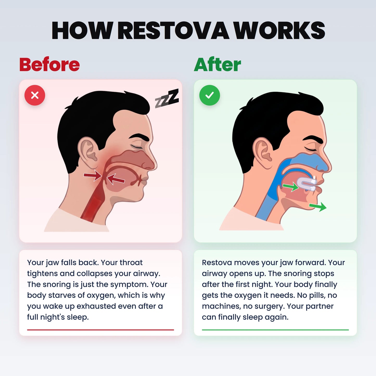 Restova Anti-Snoring Mouthpiece Universal Size