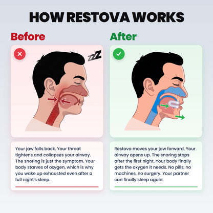 Restova Anti-Snoring Mouthpiece Universal Size